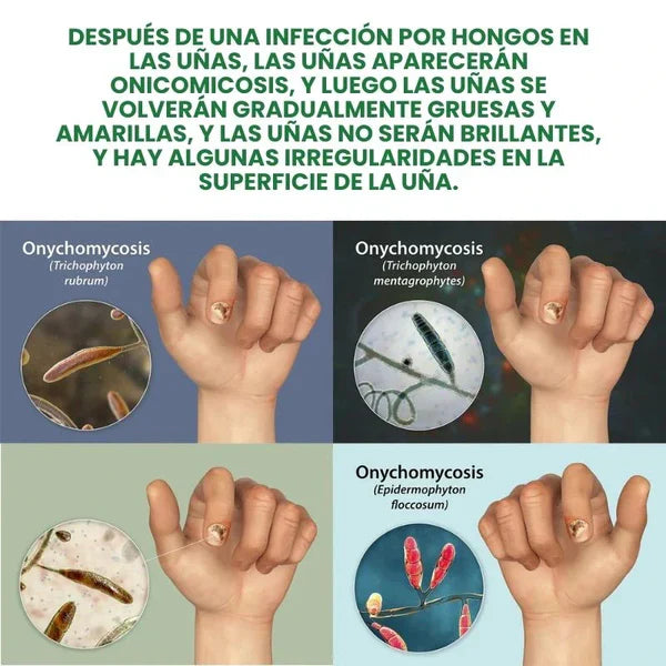 Compra 1 y llevate 2👋🦠 Antifúngico para Unhas - 7 Days™ 2UNID 30ml