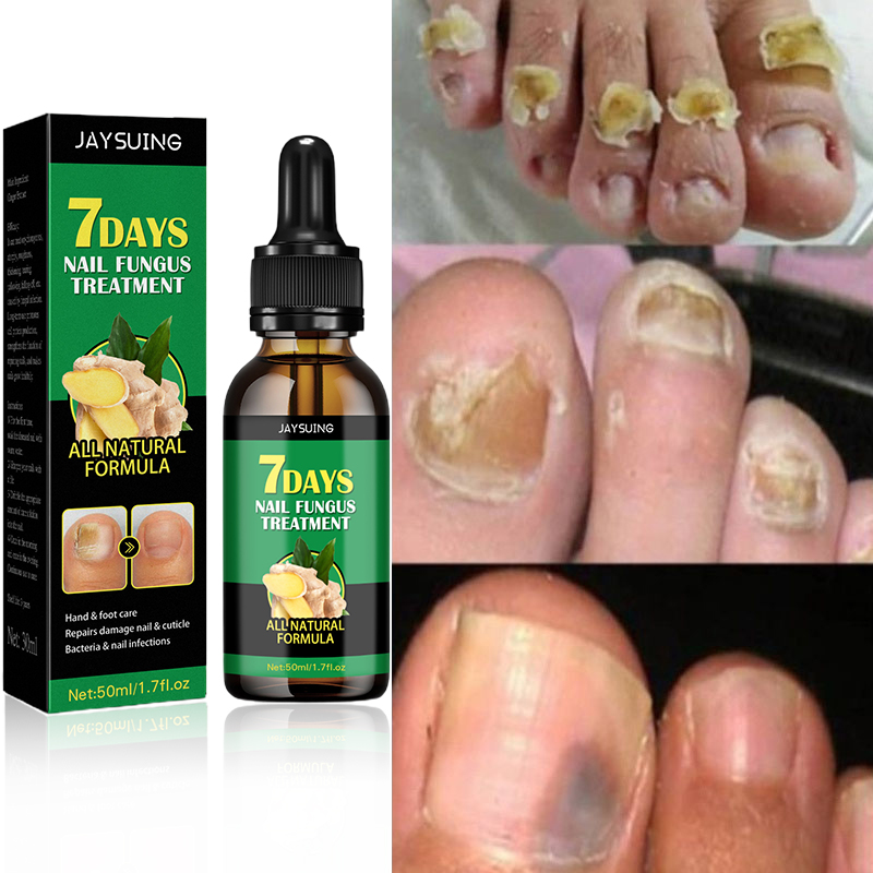 Compra 1 y llevate 2👋🦠 Antifúngico para Unhas - 7 Days™ 2UNID 30ml