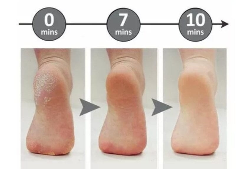 Callus Terminator ( Removedor de callos)⚡️70%OFF - OFERTA⚡️ Belleza Tienda Aparatto 