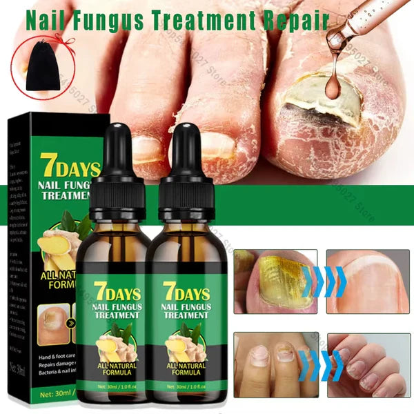 Compra 1 y llevate 2👋🦠 Antifúngico para Unhas - 7 Days™ 2UNID 30ml
