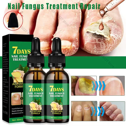 Compra 1 y llevate 2👋🦠 Antifúngico para Unhas - 7 Days™ 2UNID 30ml